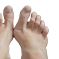 What’s Behind Curled Toes? Causes of Claw Toe Deformity You Should Know