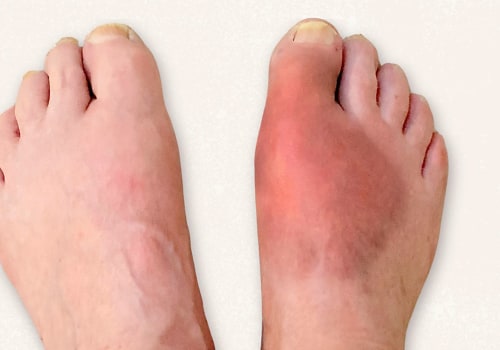 Expert's Guide to Common Foot Problems: Understanding Symptoms and Treatment Options